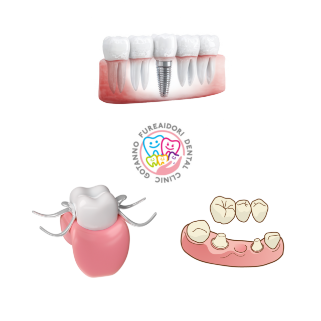 インプラント　ブリッジ　　　入れ歯