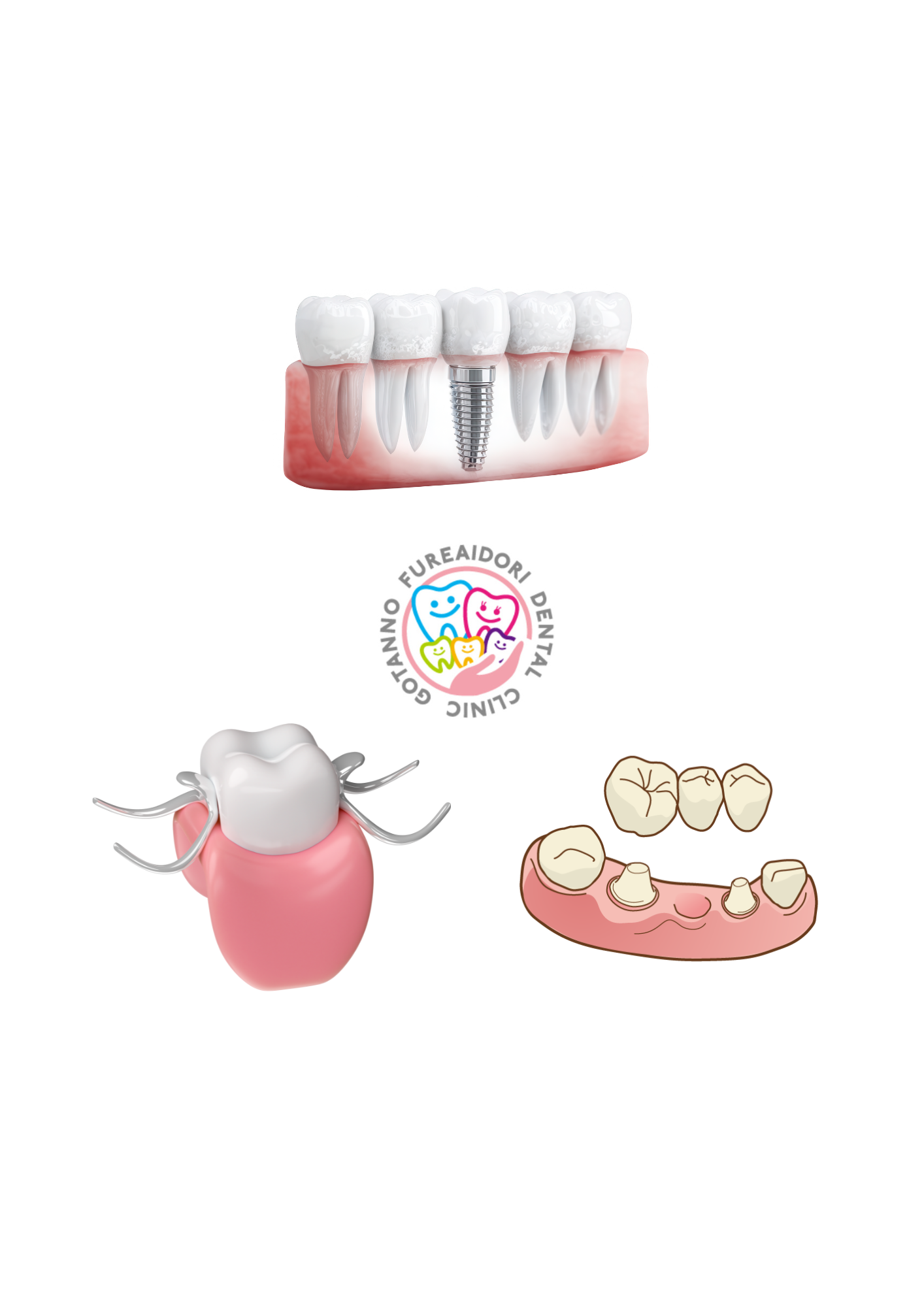 インプラント ブリッジ 入れ歯